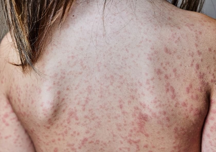 Contact Dermatitis in Adults