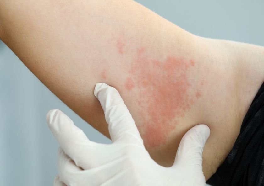 How is hives (urticaria) treated